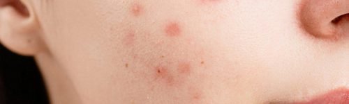 pexels-photo-6475987-6475987 A detailed close-up of a woman's face showing acne blemishes on her skin.